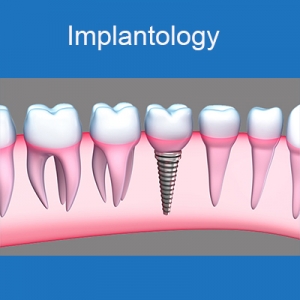 Dental Implantology Courses in India at reasonable prices an